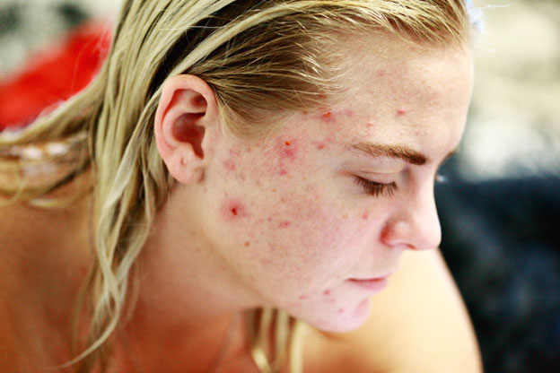 One of the primary causes of acne