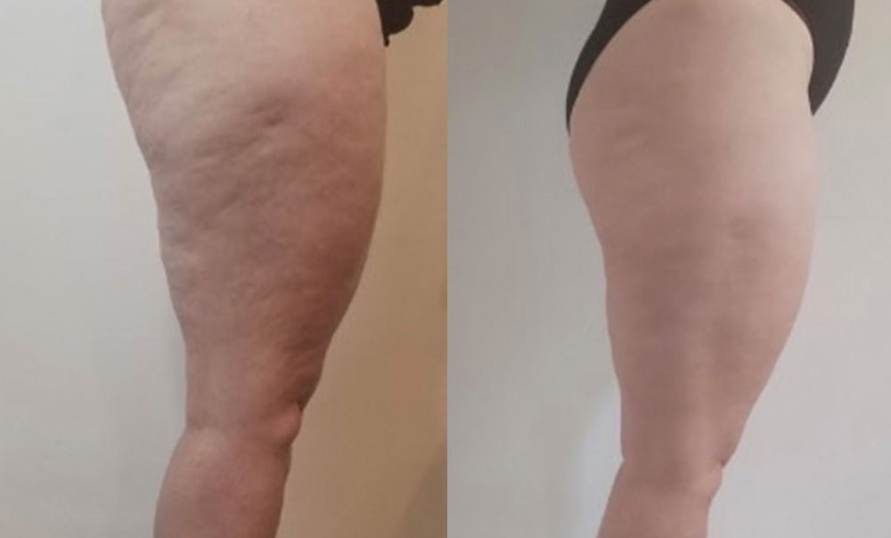 Cellulite Reduction Mesotherapy Harley Street Before After